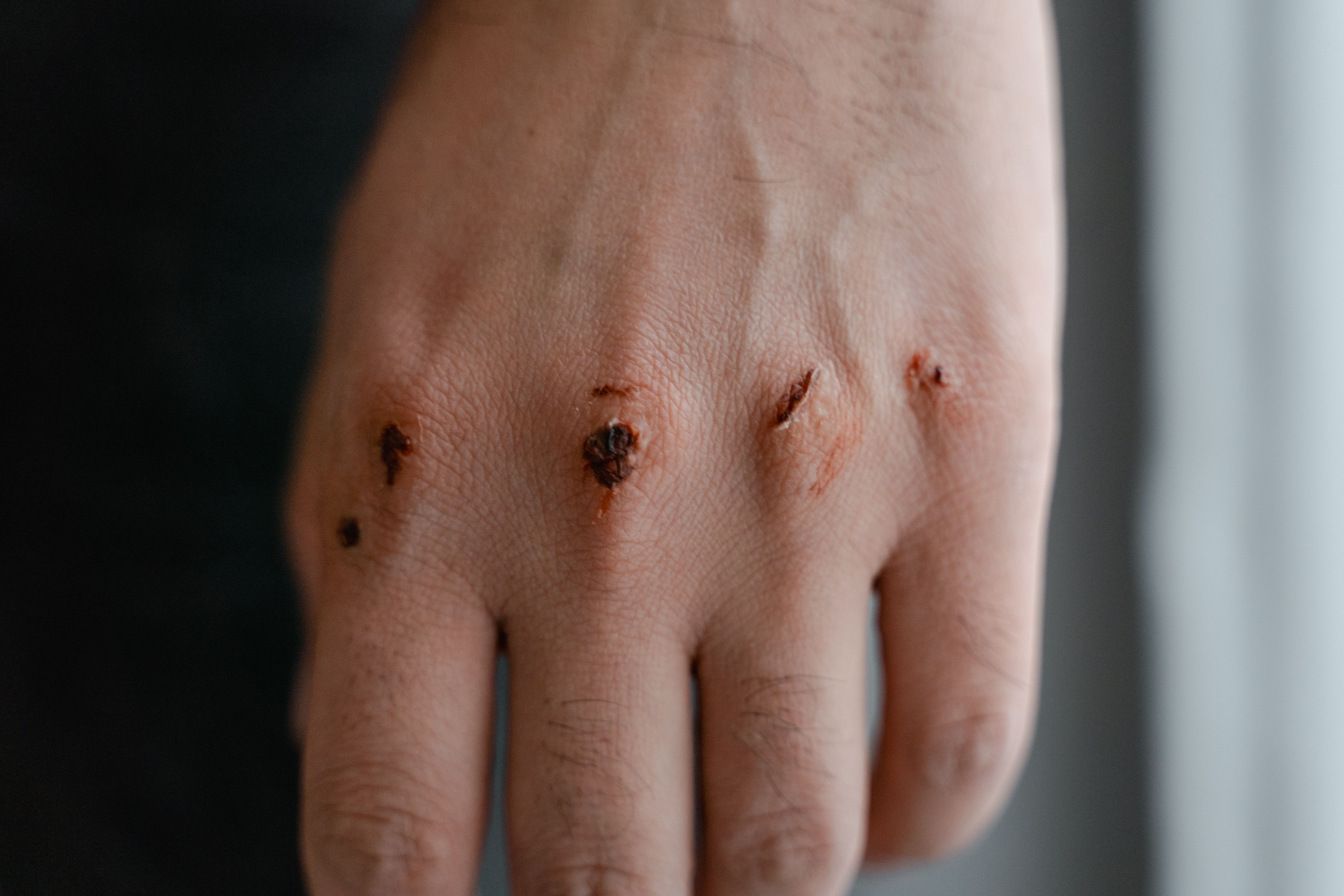 Wound & Dressing Care support by Pulse Clinic