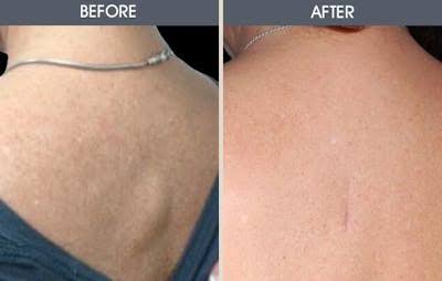 Lipoma Removal Treatment