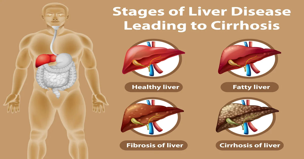 Liver Disease11111